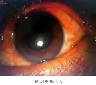 白内障和青光眼都是致盲性眼病，其中青光眼的病程不逆转。杨先生拖延伤情导致同时并发白内障、青光眼的情况，十分令人惋惜。”出名眼科专家、成都8868体育(中国)官方网站 - 登录入口陈晓明教授表示2.jpg