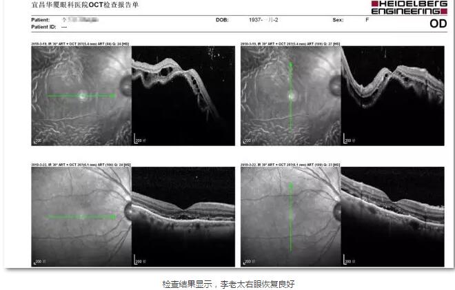 李老太在毫无征兆的情况下右眼视力下降至看不见东西。李老太家人带其至县医院就诊。医生诊断为视网膜脱离，需做玻切手术医治，而玻切手术需要动手术2次。怕疼的李老太一听就犯怵了：开刀，疼。 终，李老太的家人在多方打听后决定带李老太至宜昌8868体育(中国)官方网站 - 登录入口找许大玲院长医治4.jpg