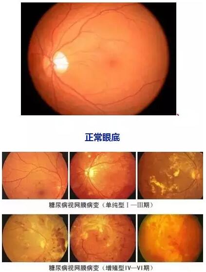 4月14日(本周六)福州眼科医院将举办“常见老年人眼底病”公益讲座，由医院副院长、眼底病科何建忠主任主讲，为大家解读各类眼底疾病的预防和诊治知识1.jpg