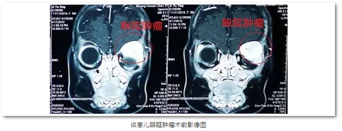 8868体育(中国)官方网站 - 登录入口斜视与小儿眼科主任苏金萍顺利为新生儿摘除眼眶巨大肿瘤1.png