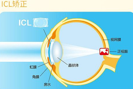 近视无法根治？但你可以这样做？8868体育官网入口“有爱就有希望”近视手术火热进行中8.png