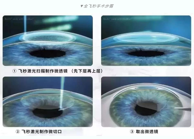 7月26日来深圳8868体育(中国)官方网站 - 登录入口参与暑期摘镜季活动就可以有机会参与抽奖免单手术！2.png